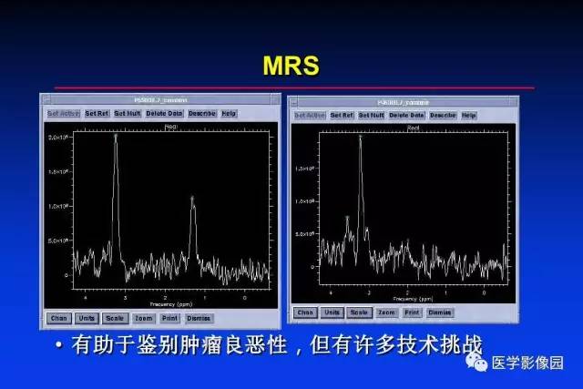 【PPT】骨肿瘤影像分析方法和诊断思路