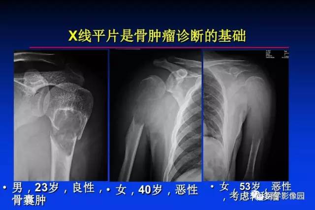 【PPT】骨肿瘤影像分析方法和诊断思路