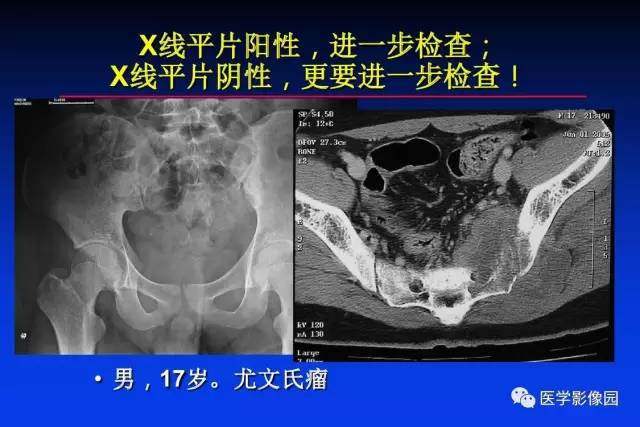 【PPT】骨肿瘤影像分析方法和诊断思路