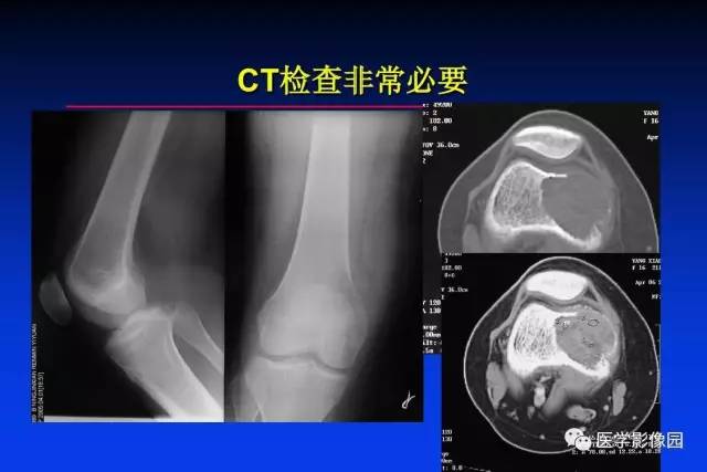 【PPT】骨肿瘤影像分析方法和诊断思路