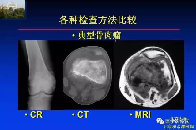 【PPT】骨肿瘤影像分析方法和诊断思路