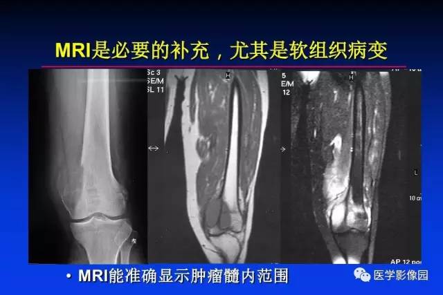【PPT】骨肿瘤影像分析方法和诊断思路
