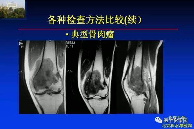 【PPT】骨肿瘤影像分析方法和诊断思路