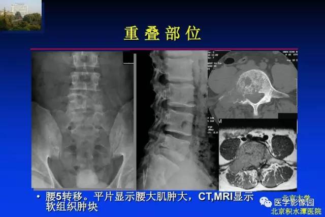 【PPT】骨肿瘤影像分析方法和诊断思路
