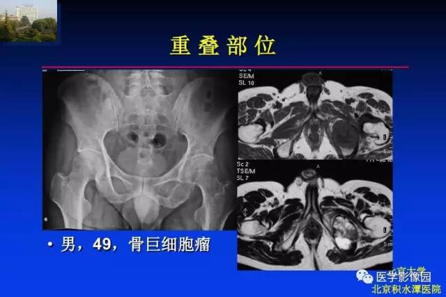 【PPT】骨肿瘤影像分析方法和诊断思路
