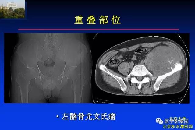 【PPT】骨肿瘤影像分析方法和诊断思路