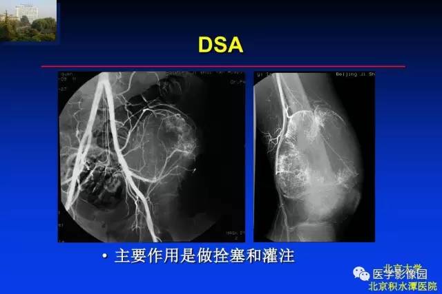 【PPT】骨肿瘤影像分析方法和诊断思路