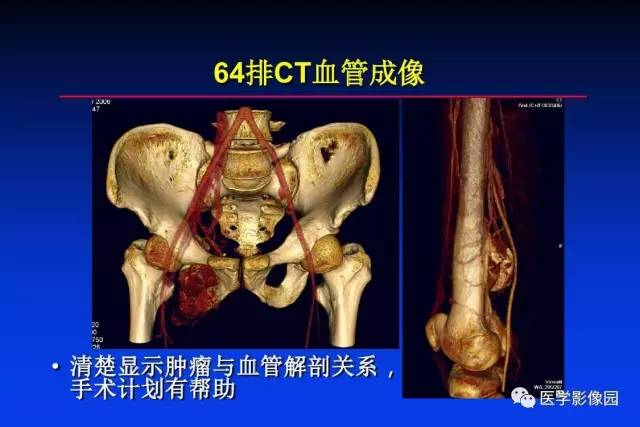 【PPT】骨肿瘤影像分析方法和诊断思路