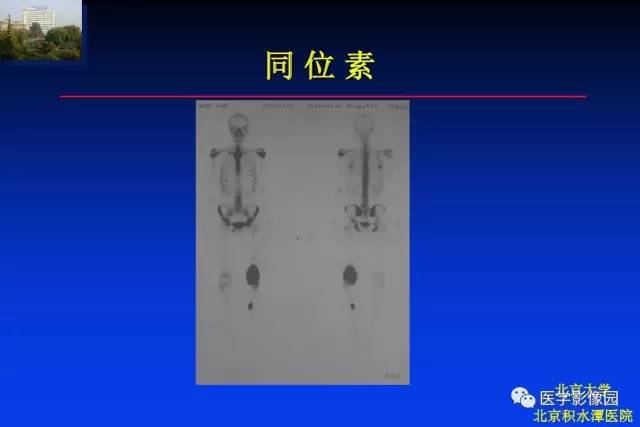 【PPT】骨肿瘤影像分析方法和诊断思路