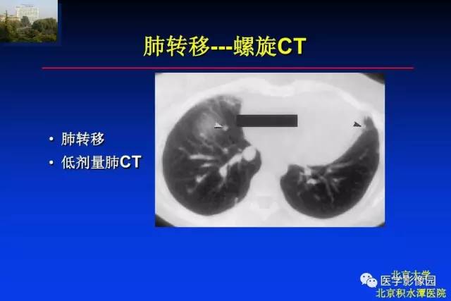 【PPT】骨肿瘤影像分析方法和诊断思路