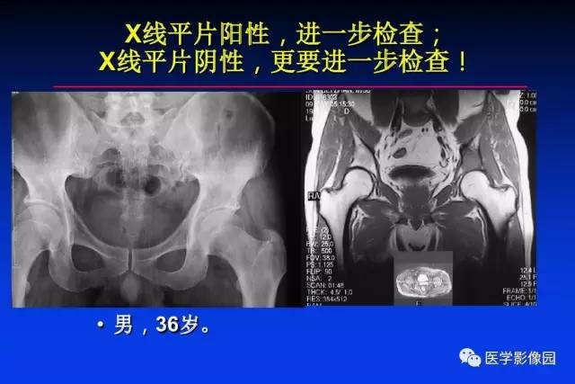 【PPT】骨肿瘤影像分析方法和诊断思路