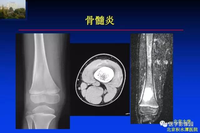 【PPT】骨肿瘤影像分析方法和诊断思路