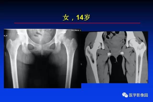 【PPT】骨肿瘤影像分析方法和诊断思路