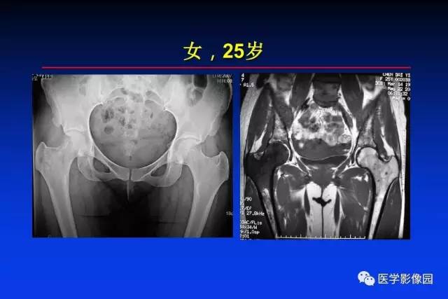 【PPT】骨肿瘤影像分析方法和诊断思路