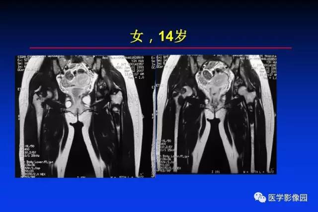 【PPT】骨肿瘤影像分析方法和诊断思路