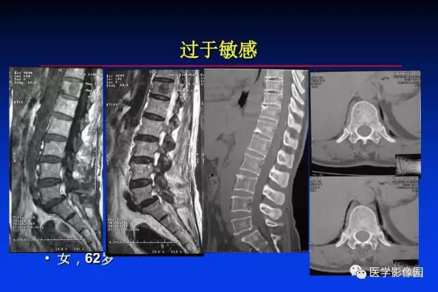 【PPT】骨肿瘤影像分析方法和诊断思路