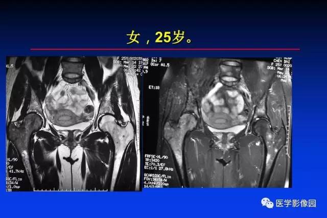 【PPT】骨肿瘤影像分析方法和诊断思路