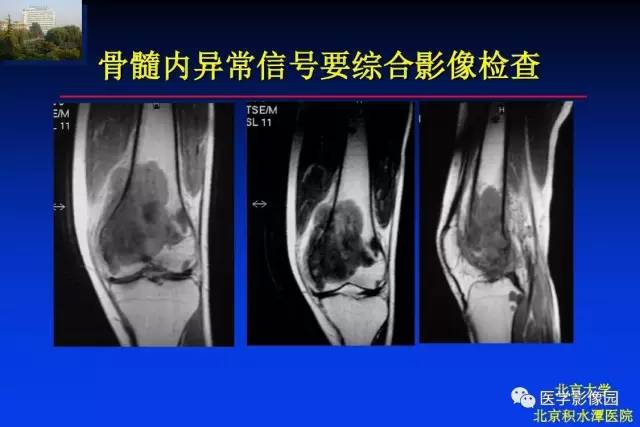 【PPT】骨肿瘤影像分析方法和诊断思路