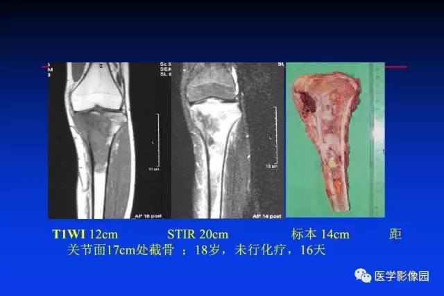 【PPT】骨肿瘤影像分析方法和诊断思路