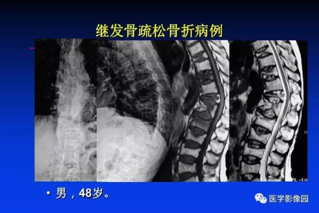 【PPT】骨肿瘤影像分析方法和诊断思路