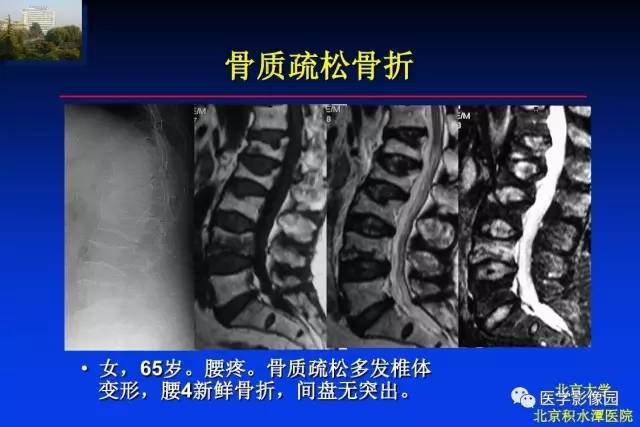 【PPT】骨肿瘤影像分析方法和诊断思路