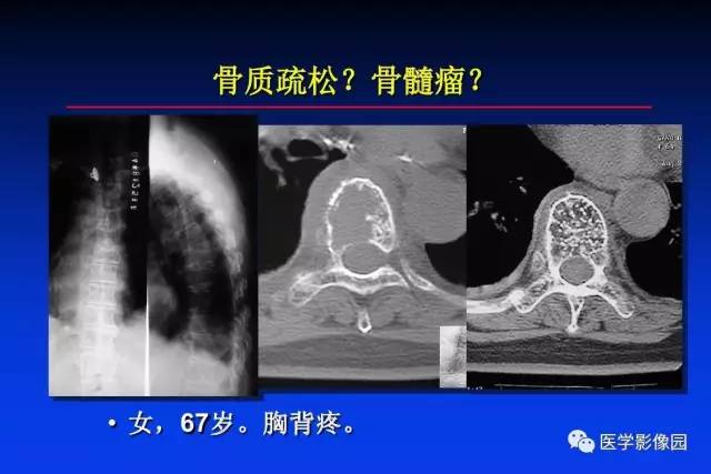 【PPT】骨肿瘤影像分析方法和诊断思路