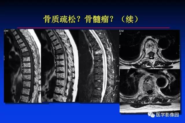 【PPT】骨肿瘤影像分析方法和诊断思路