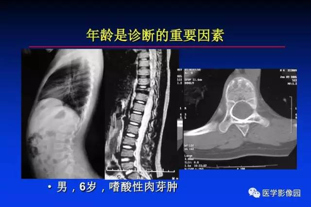 【PPT】骨肿瘤影像分析方法和诊断思路