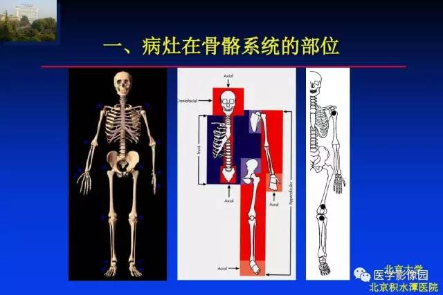 【PPT】骨肿瘤影像分析方法和诊断思路
