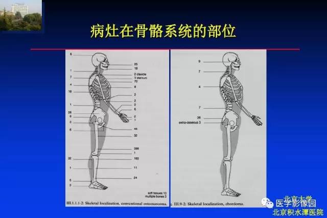 【PPT】骨肿瘤影像分析方法和诊断思路
