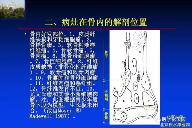 【PPT】骨肿瘤影像分析方法和诊断思路