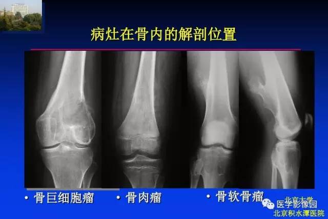 【PPT】骨肿瘤影像分析方法和诊断思路