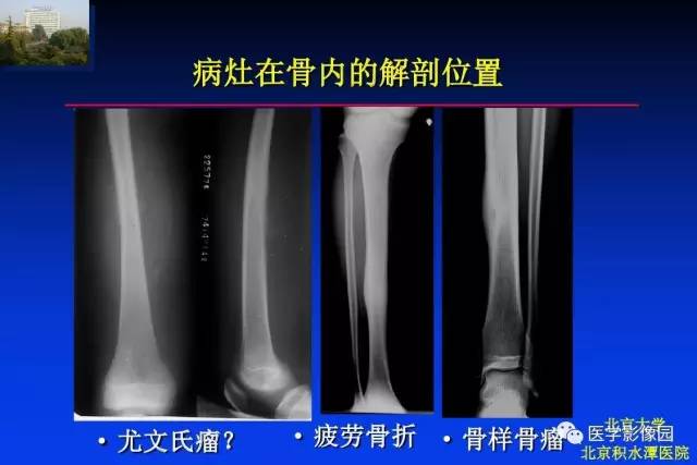 【PPT】骨肿瘤影像分析方法和诊断思路