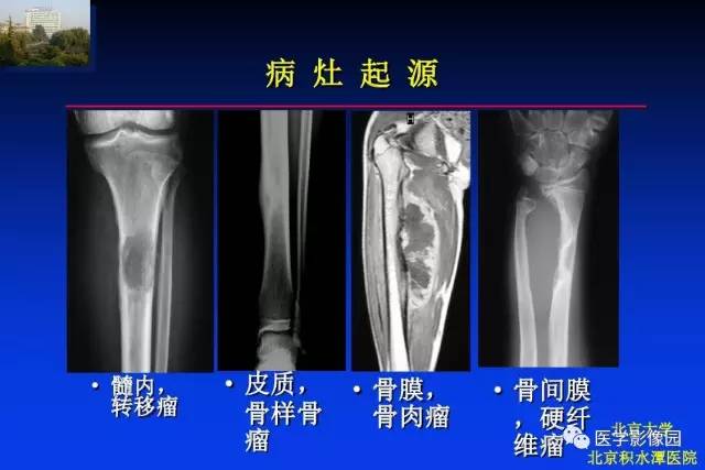 【PPT】骨肿瘤影像分析方法和诊断思路