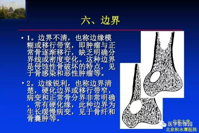 【PPT】骨肿瘤影像分析方法和诊断思路