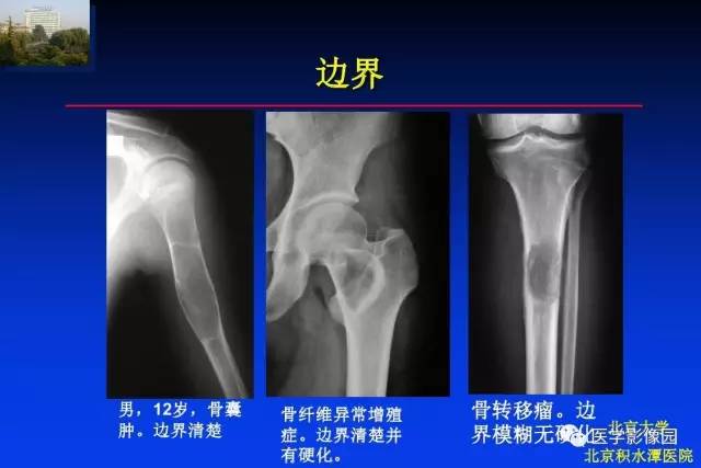 【PPT】骨肿瘤影像分析方法和诊断思路