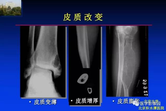 【PPT】骨肿瘤影像分析方法和诊断思路