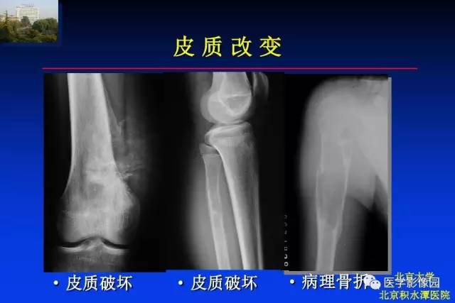 【PPT】骨肿瘤影像分析方法和诊断思路