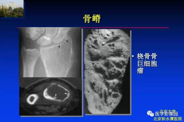 【PPT】骨肿瘤影像分析方法和诊断思路