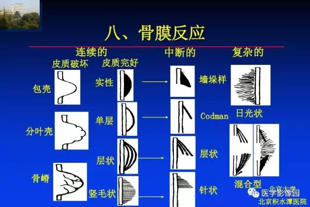 【PPT】骨肿瘤影像分析方法和诊断思路