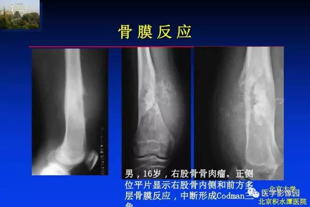 【PPT】骨肿瘤影像分析方法和诊断思路