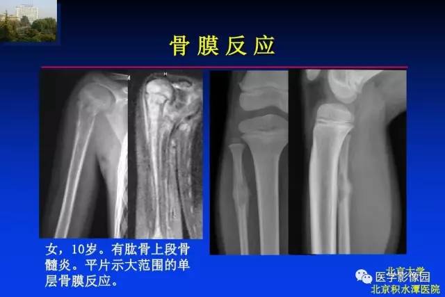 【PPT】骨肿瘤影像分析方法和诊断思路
