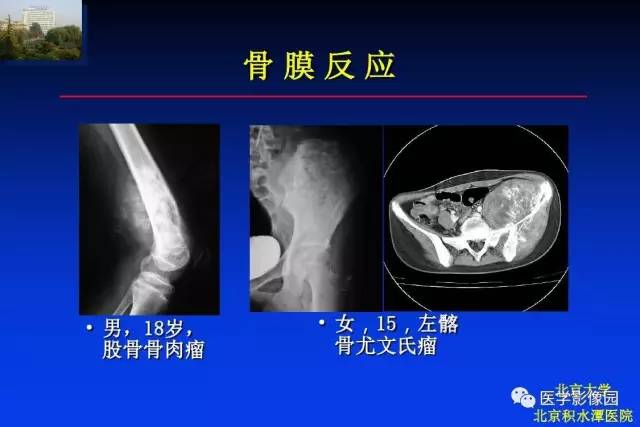 【PPT】骨肿瘤影像分析方法和诊断思路
