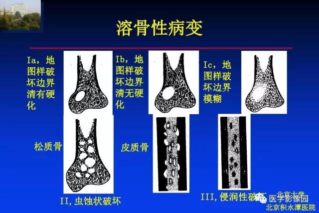 【PPT】骨肿瘤影像分析方法和诊断思路