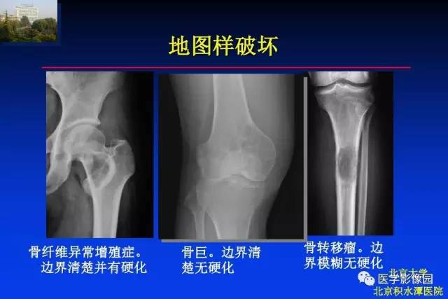 【PPT】骨肿瘤影像分析方法和诊断思路