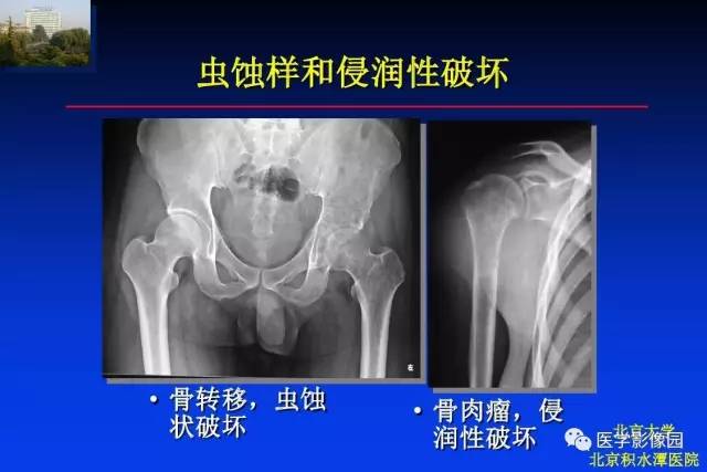 【PPT】骨肿瘤影像分析方法和诊断思路