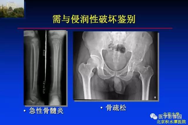 【PPT】骨肿瘤影像分析方法和诊断思路
