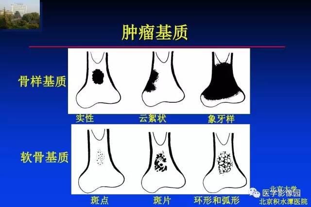 【PPT】骨肿瘤影像分析方法和诊断思路