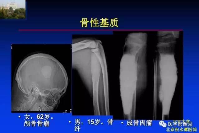 【PPT】骨肿瘤影像分析方法和诊断思路