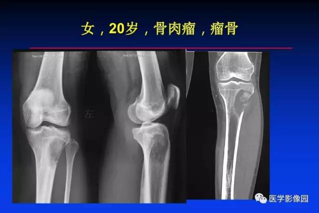【PPT】骨肿瘤影像分析方法和诊断思路